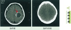 腦轉移瘤