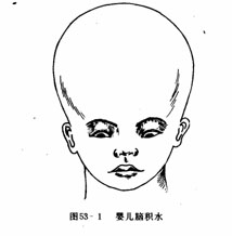 兒童腦積水