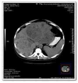 腹腔積液