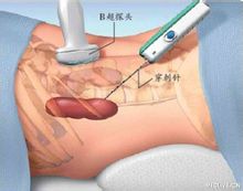 腎穿刺活檢術