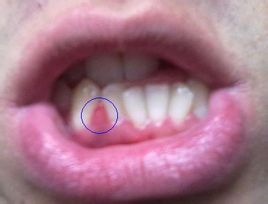 由於食物长期嵌塞和患牙缺损处粗糙边缘的刺激,牙龈乳头向龋洞增生所