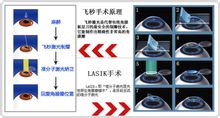 飛秒激光近視手術